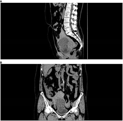 Case report: Emergency management of spontaneous rupture of the inflammatory myofibroblastic tumor of the urinary bladder